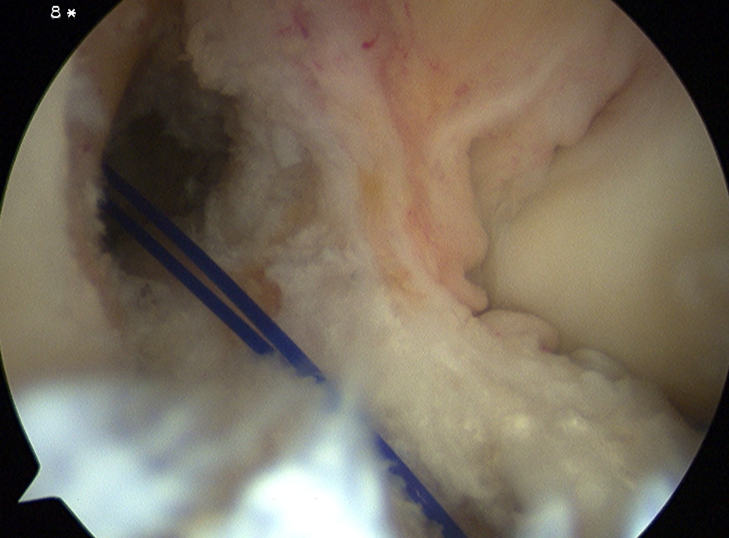 ACL Reconstruction Loop 1 Prolene Passing Suture